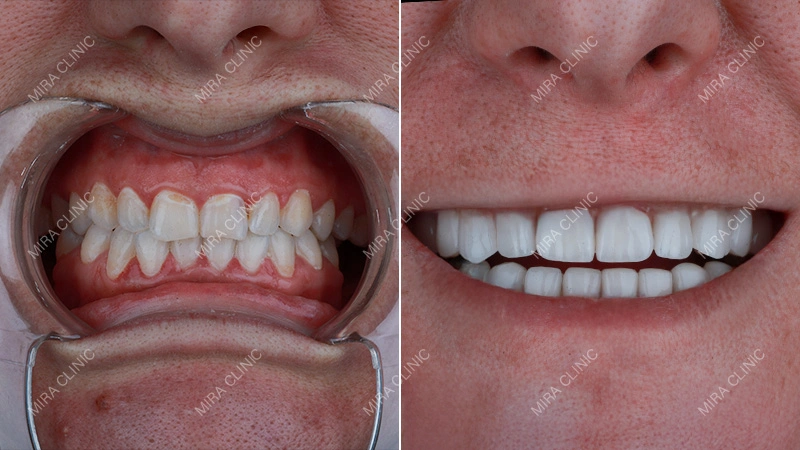 Before and After: Real Dental Crown Result
